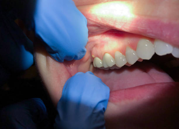 Best Chipped Tooth Repair Near Me  in Snohomish, WA