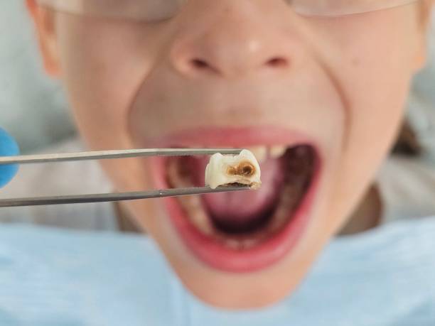 Best Broken Tooth Emergency  in Snohomish, WA